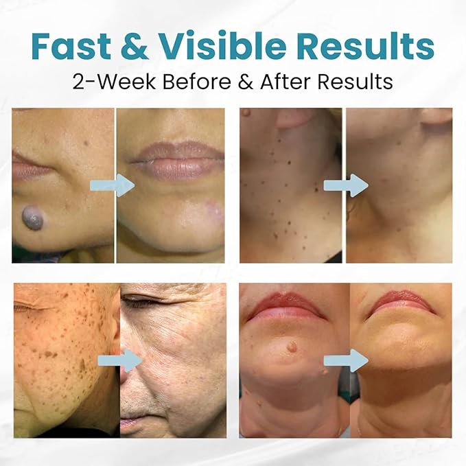 Xorita Non-Invasive Mole and Wart Removal Pen