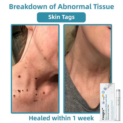 Xorita Non-Invasive Mole and Wart Removal Pen